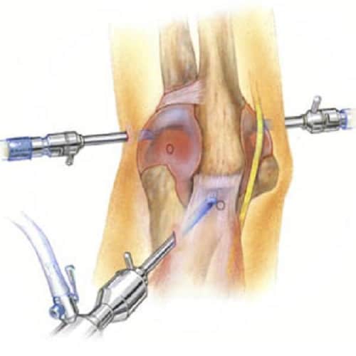 Elbow arthroscopy in Tunisia