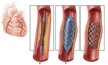 coronary angioplasty and stent placement in Tunisia