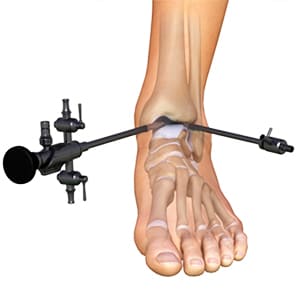 Ankle arthroscopy in Tunisia cheap price
