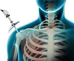 arthroscopy shoulder arthroscope tunisia price cheap price