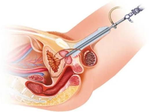 Prostate Biopsy Tunisia