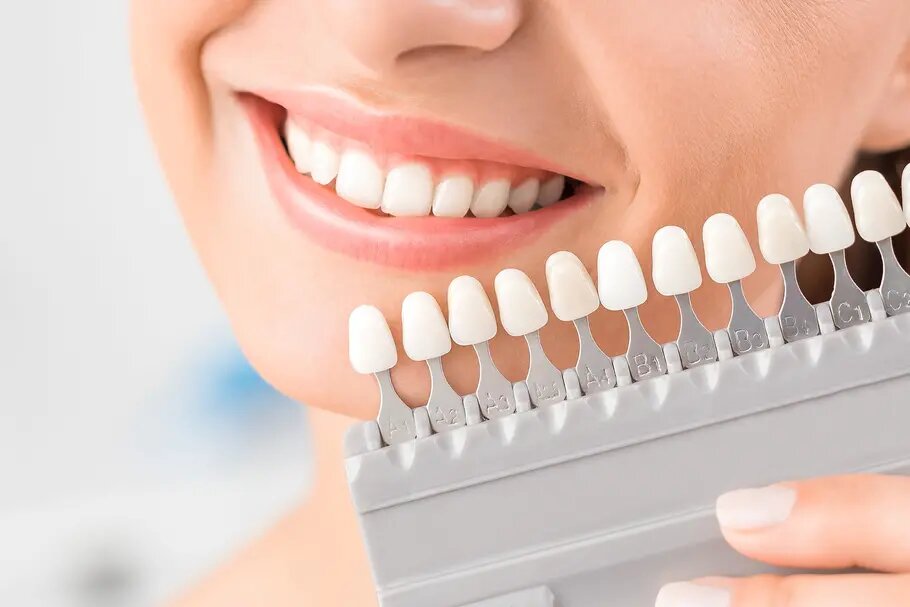 dental teeth whitening tunisia price cheap price