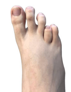 brachymetatarsia toes of the feet in Tunisia