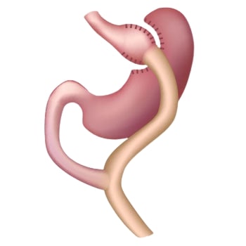Gastric bypass in Tunisia - Lasting weight loss
