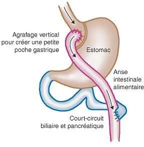 Explanatory diagram of gastric bypass in Tunisia