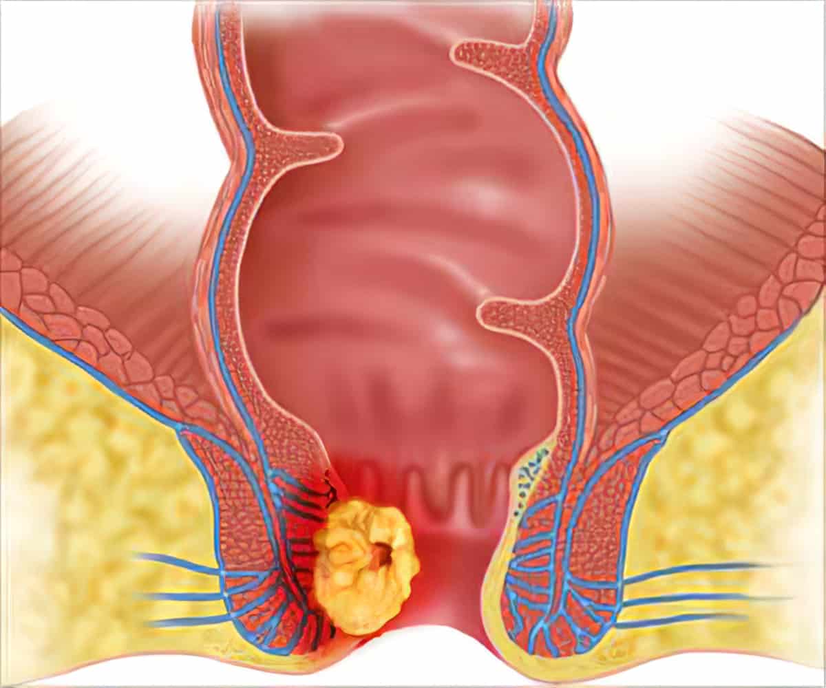 Anal canal cancer with Tunisie Esthetic