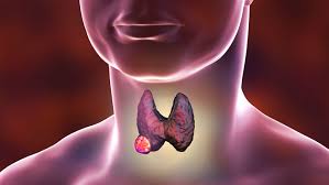 Thyroid cancer Tunisia