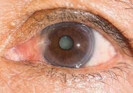 Cataract Surgery in Tunisia cheap price