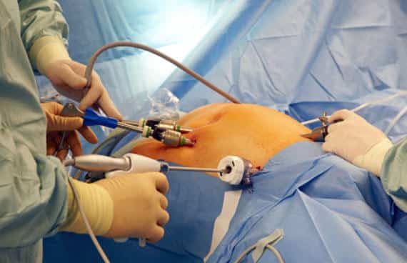 Exploratory laparoscopy in Tunisia at attractive prices