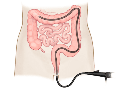 Colonoscopy Review in Tunisia at a cheap price