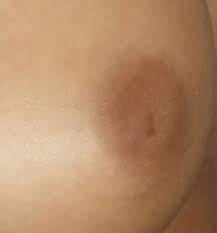 Correction of inverted nipples in Tunisia cheap price