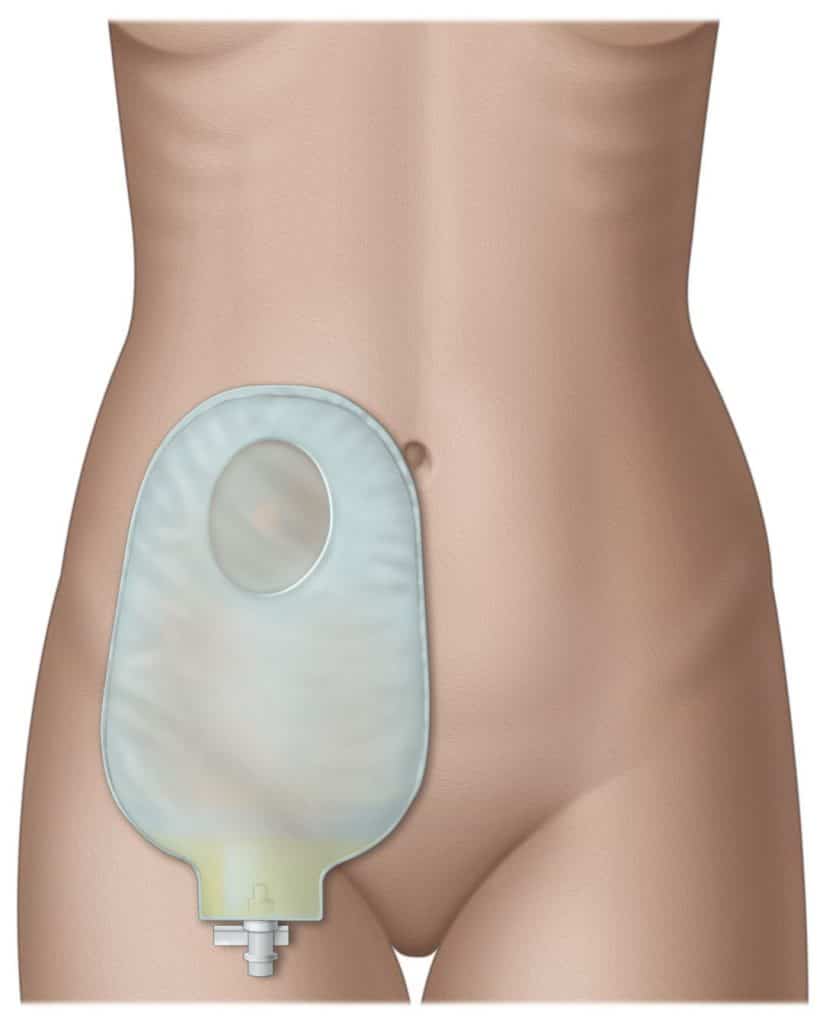 Cystectomy - urinary diversionTunisia cheap price