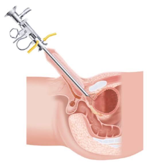Cystoscopy Tunisia