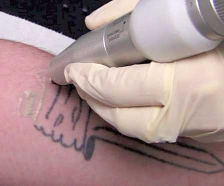 laser tattoo removal tunisia price cheap price