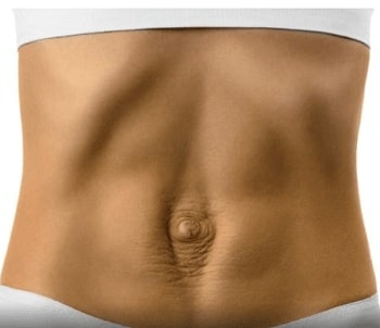 Abdominal diastasis in Tunisia