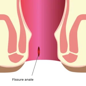 anal fissure tunisia price cheap price