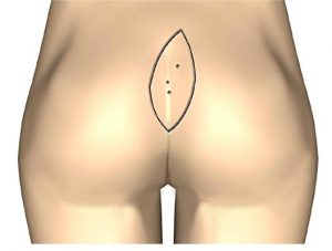 Coccygeal fistula - sacrococcygeal cyst in Tunisia