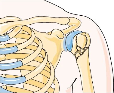 Treatment of fractured shoulder in Tunisia