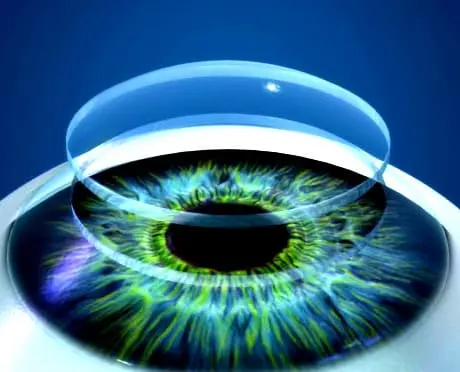 Cornea transplant in Tunisia - Keratoplasty