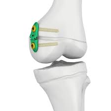 Hemiepiphysiodesis correction genu valgum varum Tunisia