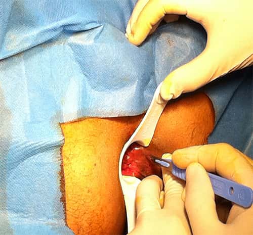 Laser hemorrhoidectomy or hemorroidoplasty in Tunisia cheap price