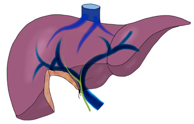 Liver surgery (hepatectomy) with Tunisie Esthetic