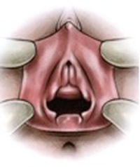 Hymenoplasty - intimate surgery in Tunisia