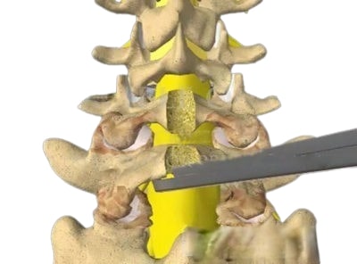 Yellow Ligament Hypertrophy in Tunisia