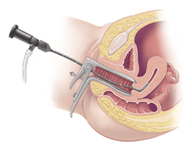 Hysteroscopy - endoscopic examination of the uterus in Tunisia