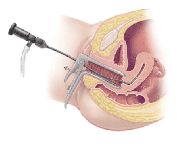 Hysteroscopy - endoscopic gynecology in Tunisia at a cheap price