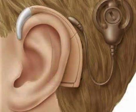 Cochlear Implant - Treatment in Tunisia