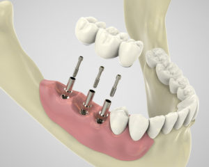 dental implant tunisia price cheap price