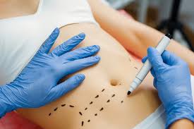 Lipolysis injection treatment for localized fat Tunisia
