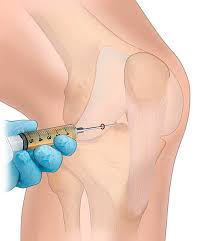 Intra-articular injections Tunisia