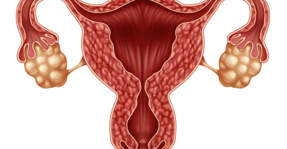 Ovarian cysts - Gynecological surgery in Tunisia