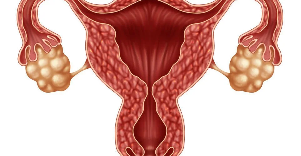 Treatments for Ovarian Cysts in Tunisia at a cheap price