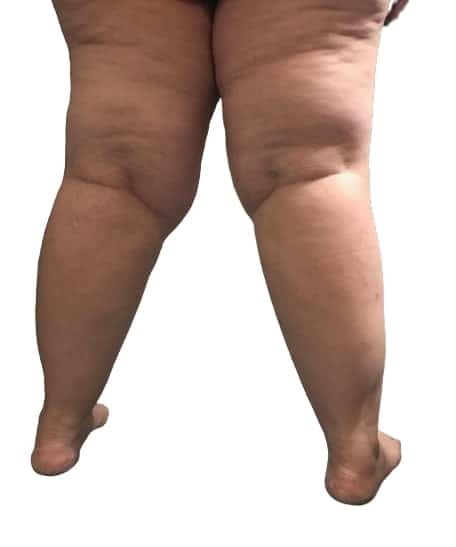 How Can I Slow the Likely Progression of My Lipedema? - Total Lipedema Care