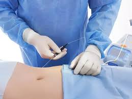 Vaser liposuction treatment for localized fat Tunisia