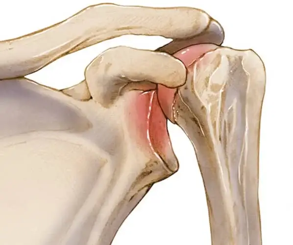shoulder dislocation tunisia price cheap price