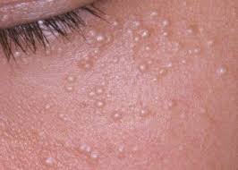 Hard Milia treatment Tunisia