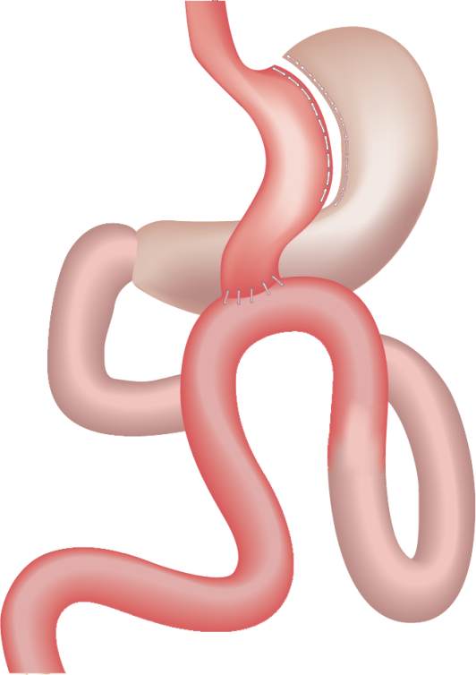 Mini Gastric Bypass - Bariatric Surgery in Tunisia