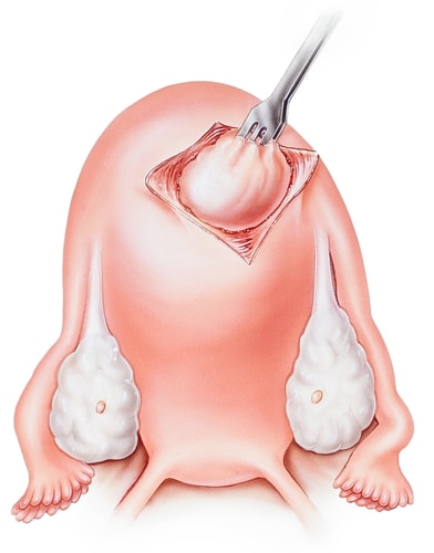 Myomectomy - Removal of uterine fibroids in Tunisia