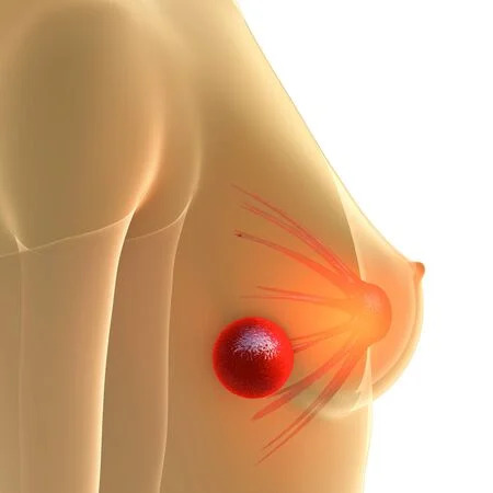Breast Nodule - Diagnosis and Treatment in Tunisia