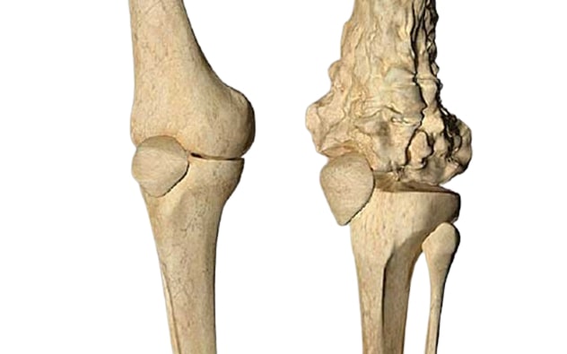 Osteosarcoma in Tunisia