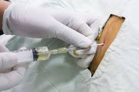 Ascites puncture Tunisia