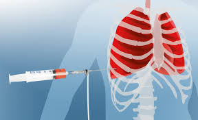 Pleural puncture Tunisia