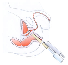 Prostatectomy in Tunisia - Prostate removal Prostatectomy: prostate removal surgery for cancer in Tunisia