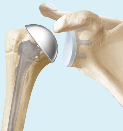 Shoulder prosthesis in Tunisia at a cheap price