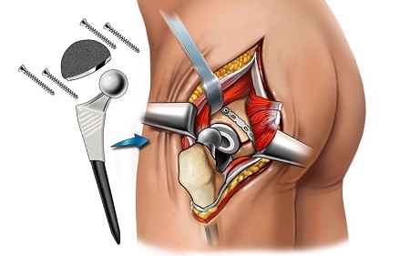 Total hip replacement in Tunisia - THR surgery