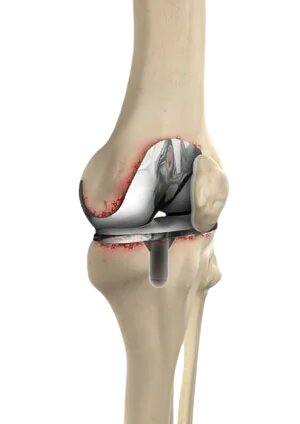 total knee prosthesis